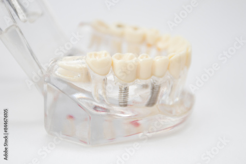 A demonstration jaw with an implant and an abutment