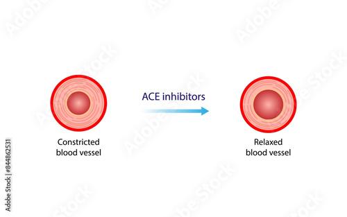 Angiotensin-converting enzyme inhibitors, ACE inhibitors. Renin-Angiotensin-Aldosterone System, blood pressure regulation. Vasoconstriction and vasodilatation. Vector illustration.