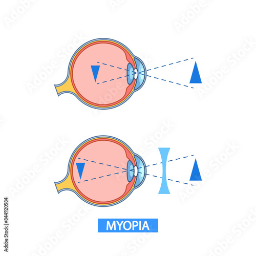 Detailed Vector Infographic Showing The Anatomy Of Myopic Eyes And The Effect Of A Corrective Lens. Medical Aids