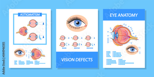 Vector Banners With Detailed Infographic Explaining Eye Anatomy, Vision Defects, And Astigmatism