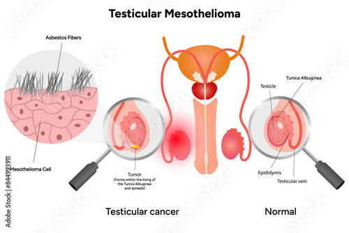 Mesothelioma disease, Testicular mesothelioma photo