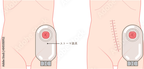 人工肛門、ストーマ、大腸、イラスト、illustration