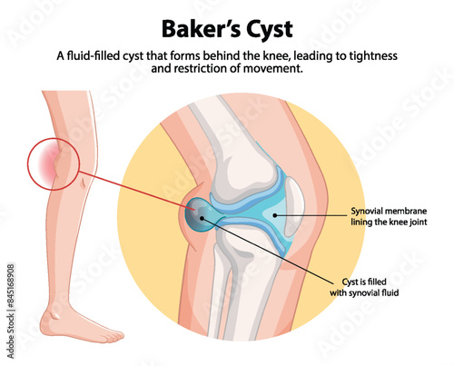 Fluid-filled cyst causing knee tightness