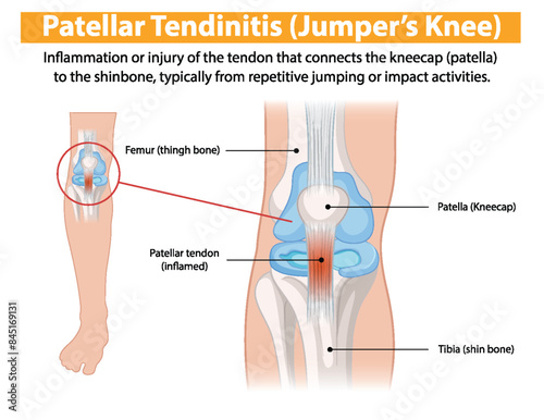 Inflammation of the patellar tendon from repetitive jumping