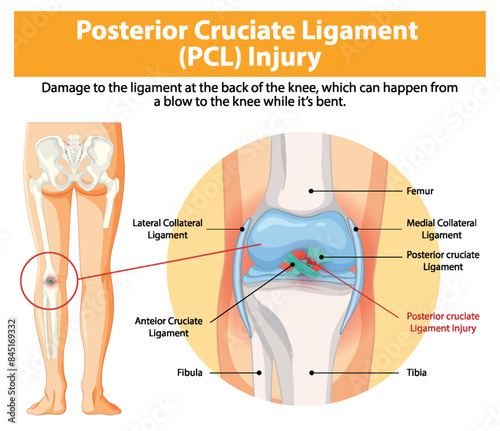 Illustration of PCL injury and knee anatomy