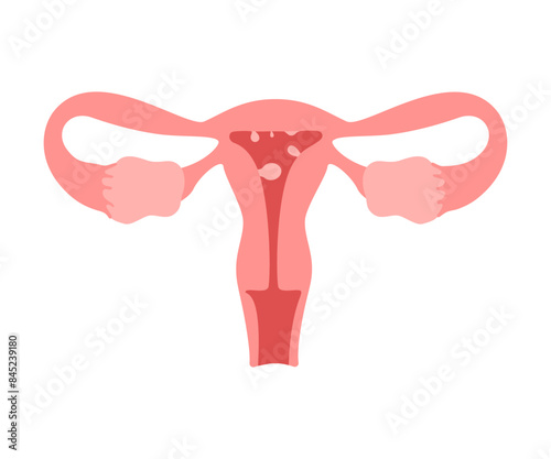 Uterus organ with polyp. Check health of woman organ. Unhealthy, internal problems, female reproductive system disease. Risk growth cancer cells in womb. Vector flat illustration