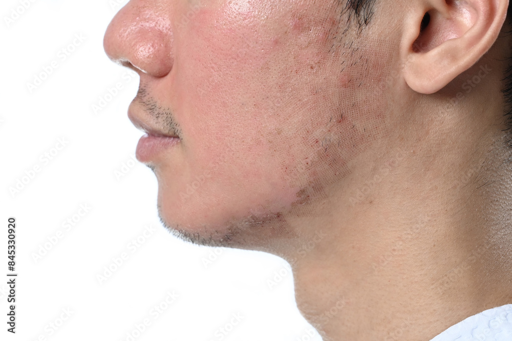 Close up of men side face after facial laser treatment on white background. Aesthetic face treatment concept Close up of men side face after facial laser treatment on white background. Aesthetic face treatment concept