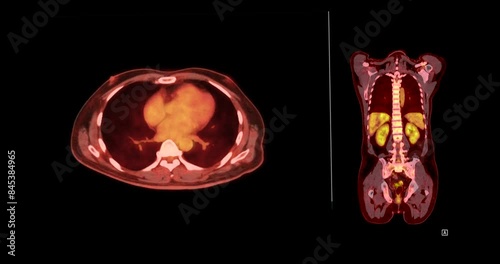 A PET CT scan reveals cholangiocarcinoma with suspected metastatic involvement of the lungs and lymph nodes.
