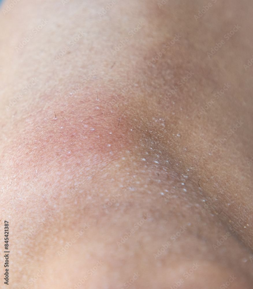 hematoma on the leg as a background. hematoma on the leg as a background.