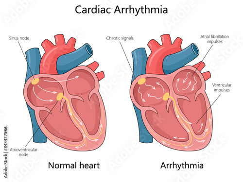 normal heart with cardiac arrhythmia, showing sinus node, chaotic signals, and atrial fibrillation diagram hand drawn schematic vector illustration. Medical science educational illustration