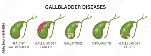 Gallbladder diseases infographics. Gallstone disease, cancer, acute cholecystitis, cholangitis or polyps of the digestive system. Problems with the biliary tract. Illustration.