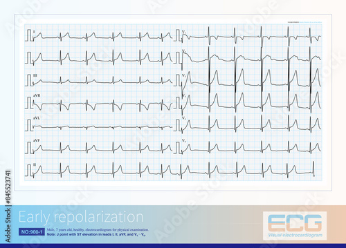 Tableau sur toile Early repolarization is a common benign ECG change that manifests as J-point ECG with or without ST-segment elevation