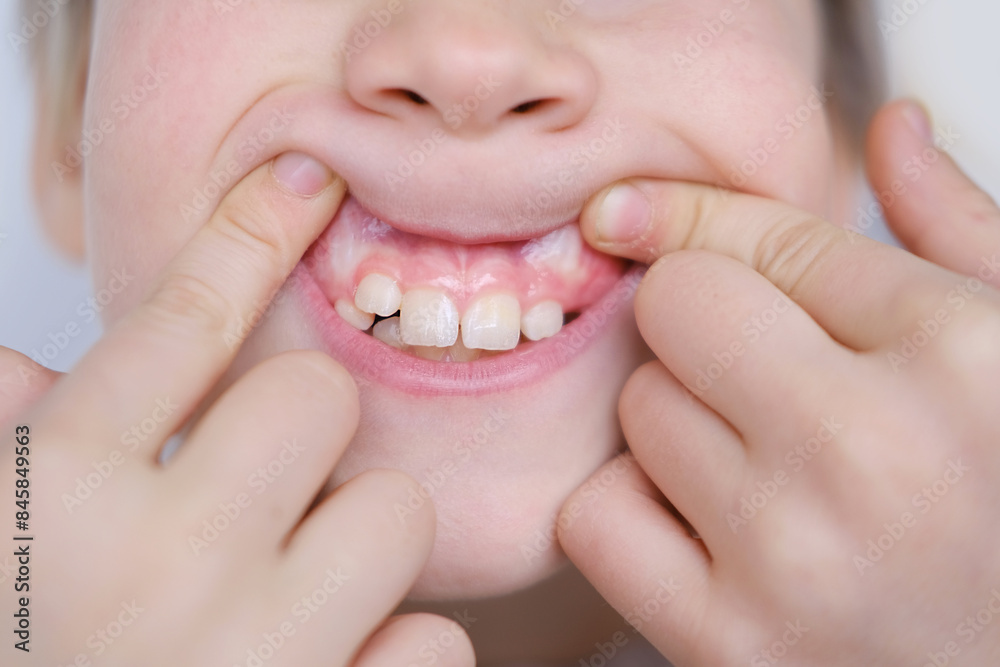 Young Smiling child, boy, age 10 reveals growing teeth, marking milestone in dental development, child's dental health, tooth eruption stage Young Smiling child, boy, age 10 reveals growing teeth, marking milestone in dental development, child's dental health, tooth eruption stage