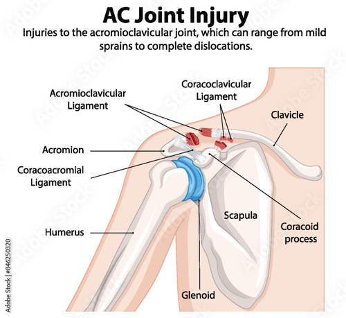 Detailed illustration of shoulder joint injury