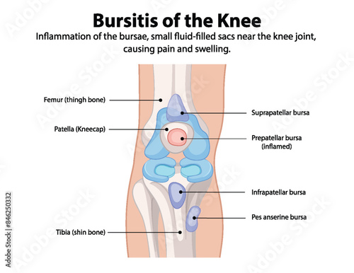 Inflammation of knee bursae causing pain and swelling