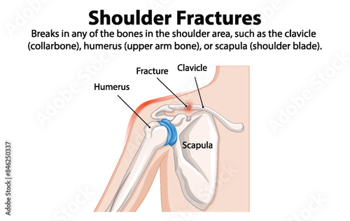 Diagram of shoulder bones and fracture locations