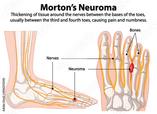 Diagram showing nerve thickening in the foot photo