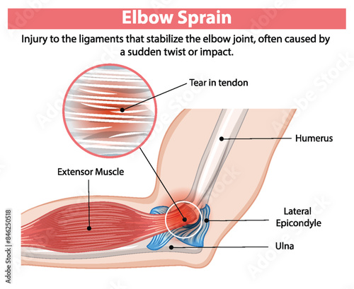 Detailed diagram of an elbow sprain