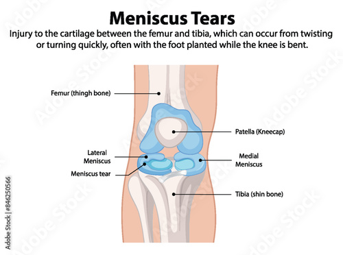 Illustration of knee meniscus tear anatomy