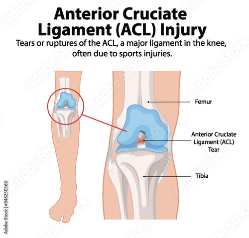 Illustration of ACL tear in the knee