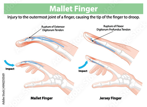 Illustration of finger tendon injuries and impacts
