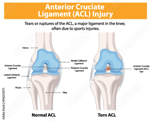 Comparison of normal and torn ACL in the knee