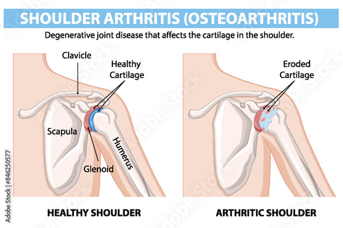 Illustration of healthy and arthritic shoulder joints