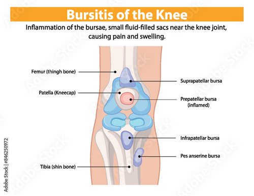 Inflammation of knee bursae causing pain and swelling
