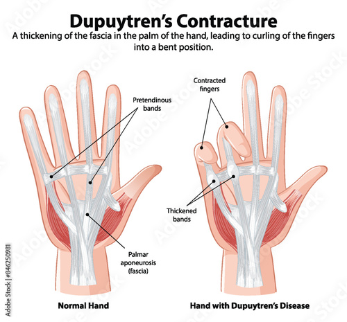 Comparison of normal hand and affected hand