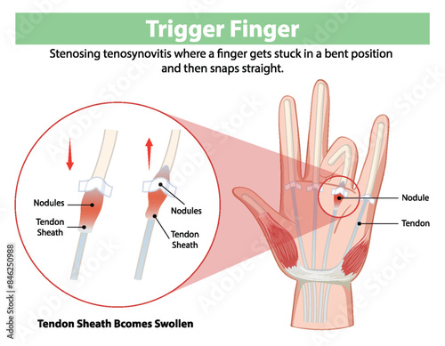 Diagram explaining trigger finger condition