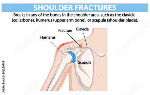 Diagram of shoulder bones and fracture locations