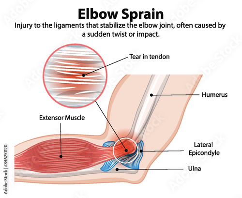 Detailed diagram of an elbow sprain injury