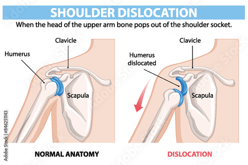 Comparison of normal and dislocated shoulder anatomy