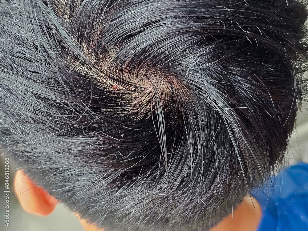 Man showing dandruff in dark hair. closeup view Man showing dandruff in dark hair. closeup view