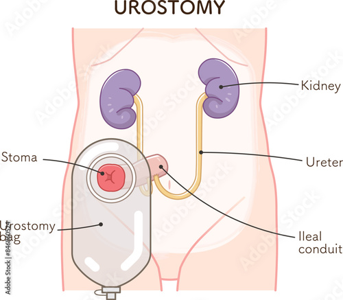 尿路ストーマ、ストーマ、ウロストミー、urostomy、オストメイト、大腸、小腸、膀胱、イラスト、illustration