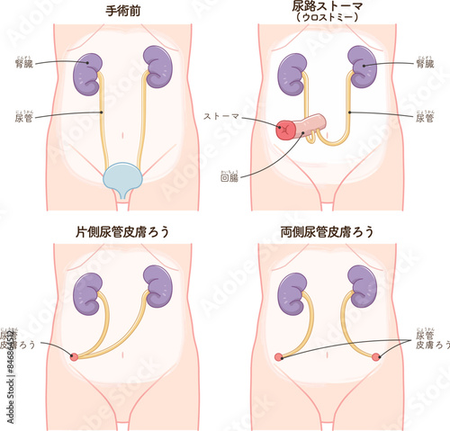 尿路ストーマ、ストーマ、ウロストミー、urostomy、オストメイト、大腸、小腸、膀胱、イラスト、illustration