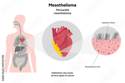 Mesothelioma, Pericardial mesothelioma zoom
