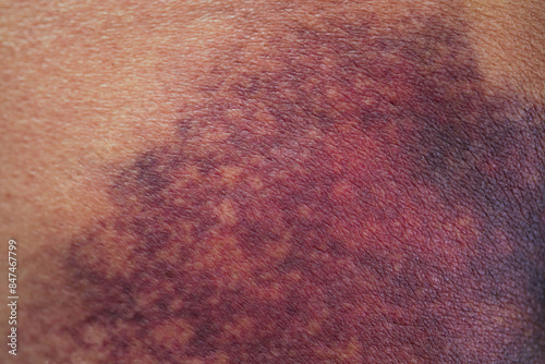 Schilderij op canvas Asian woman dark bruise on the buttocks from a slip accident in the bathroom