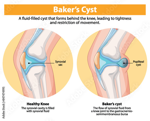 Comparison of healthy knee and Baker's cyst