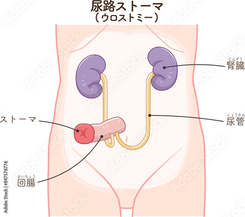 尿路ストーマ、ストーマ、ウロストミー、urostomy、オストメイト、大腸、小腸、膀胱、イラスト、illustration