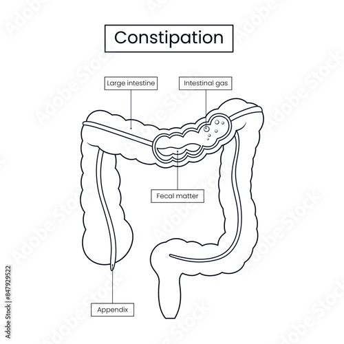 Medical design constipation sketch illustration