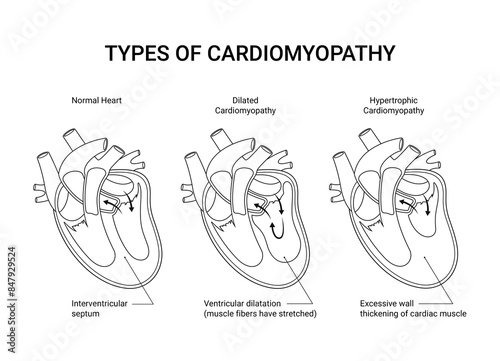 Types of cardiomyopathy sketch illustration medical design