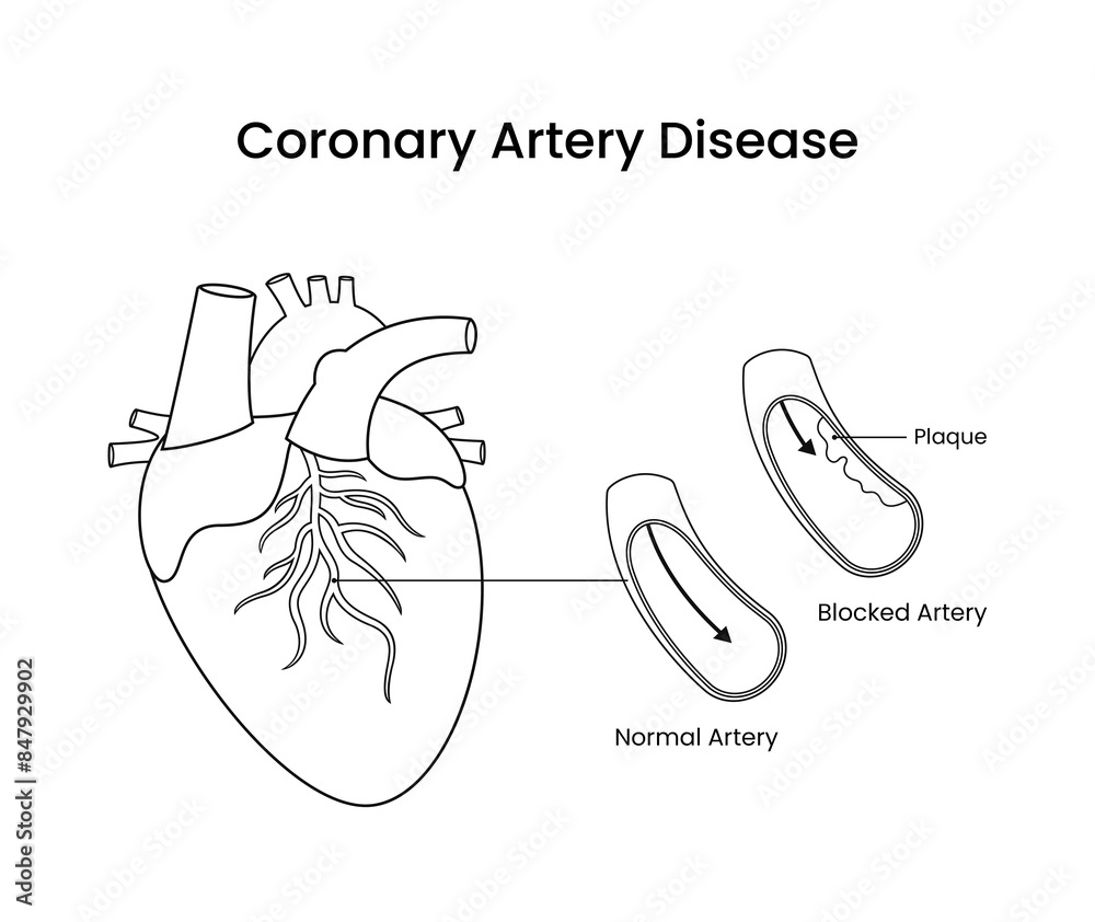 Coronary artery disease sketch illustration medical design Stock Vector ...