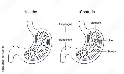 Medical design sketch of healthy stomach and gastritis stomach