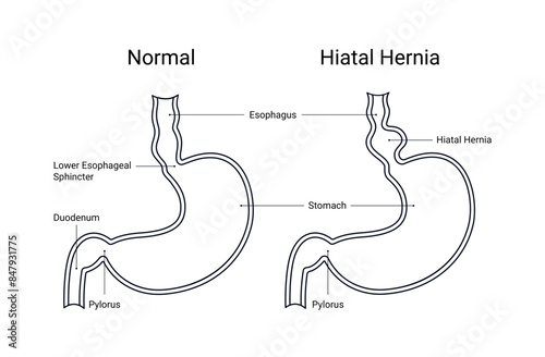 Diagram of hiatal hernia anatomical with line style