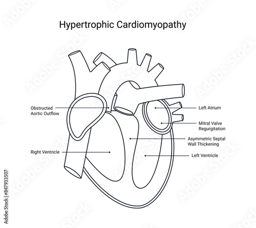Diagram of Hypertrophic Cardiomyopathy Disease in Line Style