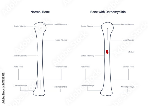 Diagram of bone with osteomyelitis disease in line style