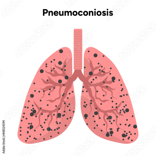 Pneumoconiosis, dust in alveoli 