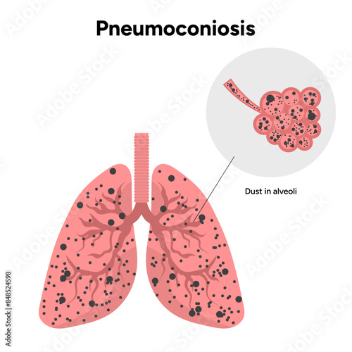 Pneumoconiosis, dust in alveoli 