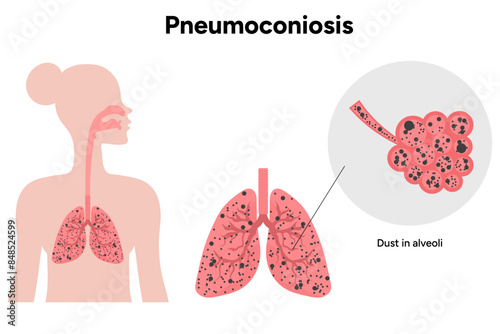 Pneumoconiosis, dust in alveoli 